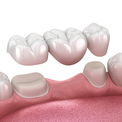 Veneers,Crowns and Bridges