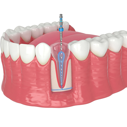 Root Canal and Advanced Root Canals