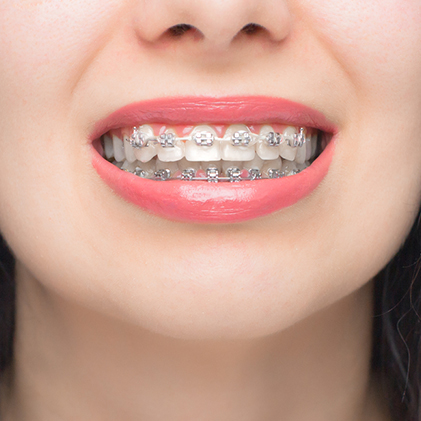 Self Ligating Braces